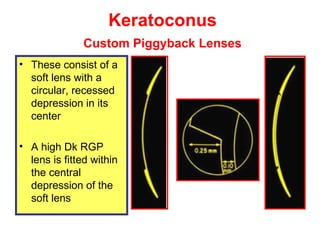 Piggyback Rgp contact lenses fitting for KCN | PPT
