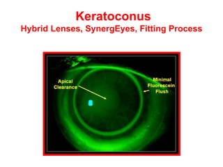 Keratoconus  Hybrid Lenses, SynergEyes, Fitting Process 