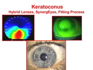Keratoconus  Hybrid Lenses, SynergEyes, Fitting Process 