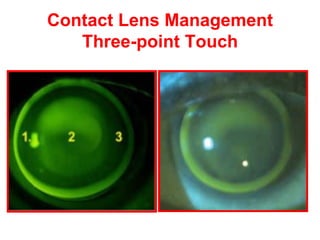 Contact Lens Management Three - point Touch 