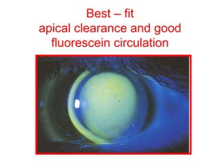 Best – fit apical clearance and good fluorescein circulation 