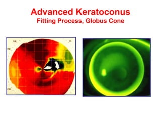 Advanced Keratoconus Fitting Process, Globus Cone 
