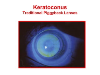 Keratoconus Traditional Piggyback Lenses 
