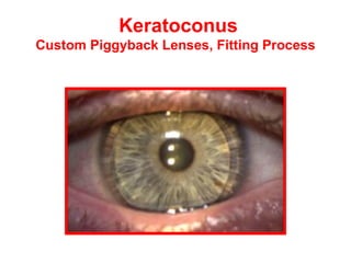 Keratoconus  Custom Piggyback Lenses, Fitting Process 