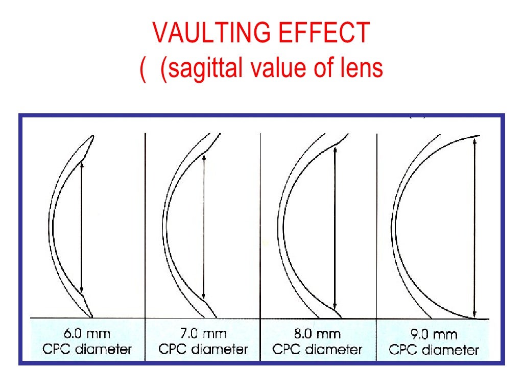 contact lenses fitting for KCN