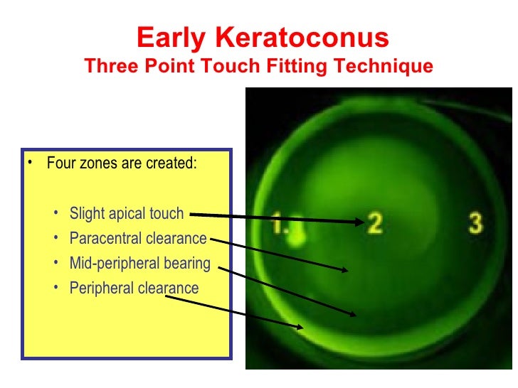 What Are The Best Contact Lenses For Keratoconus