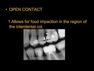 • OPEN CONTACT
1.Allows for food impaction in the region of
the interdental col.
 
