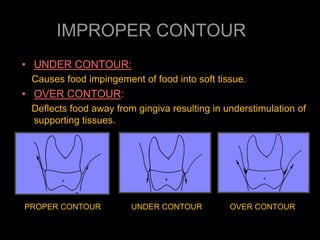 IMPROPER CONTOUR
• UNDER CONTOUR:
Causes food impingement of food into soft tissue.
• OVER CONTOUR:
Deflects food away from gingiva resulting in understimulation of
supporting tissues.
PROPER CONTOUR UNDER CONTOUR OVER CONTOUR
 