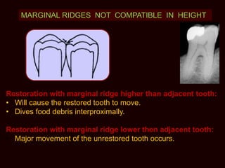 MARGINAL RIDGES NOT COMPATIBLE IN HEIGHT
Restoration with marginal ridge higher than adjacent tooth:
• Will cause the restored tooth to move.
• Dives food debris interproximally.
Restoration with marginal ridge lower then adjacent tooth:
• Major movement of the unrestored tooth occurs.
 