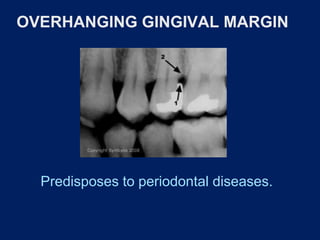 OVERHANGING GINGIVAL MARGIN
Predisposes to periodontal diseases.
 
