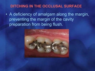 DITCHING IN THE OCCLUSAL SURFACE
• A deficiency of amalgam along the margin,
preventing the margin of the cavity
preparation from being flush.
 