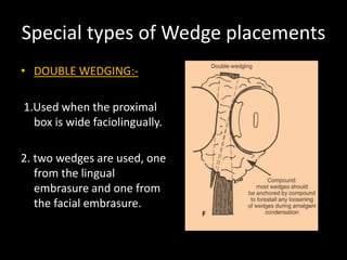 Special types of Wedge placements
• DOUBLE WEDGING:-
1.Used when the proximal
box is wide faciolingually.
2. two wedges are used, one
from the lingual
embrasure and one from
the facial embrasure.
 