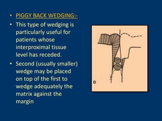 • PIGGY BACK WEDGING:-
• This type of wedging is
particularly useful for
patients whose
interproximal tissue
level has receded.
• Second (usually smaller)
wedge may be placed
on top of the first to
wedge adequately the
matrix against the
margin
 