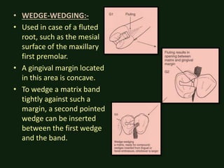 • WEDGE-WEDGING:-
• Used in case of a fluted
root, such as the mesial
surface of the maxillary
first premolar.
• A gingival margin located
in this area is concave.
• To wedge a matrix band
tightly against such a
margin, a second pointed
wedge can be inserted
between the first wedge
and the band.
 