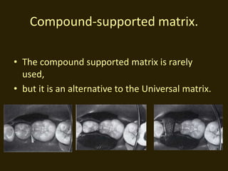 Compound-supported matrix.
• The compound supported matrix is rarely
used,
• but it is an alternative to the Universal matrix.
 