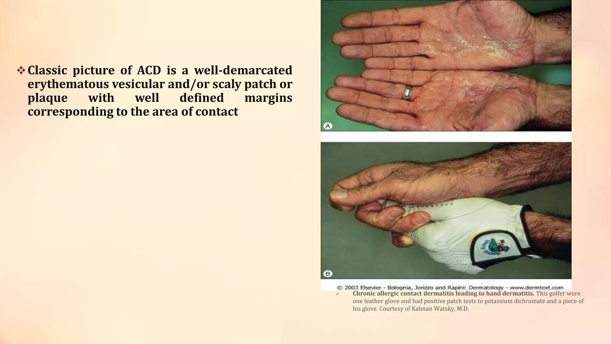 Contact dermatitis | PPTX