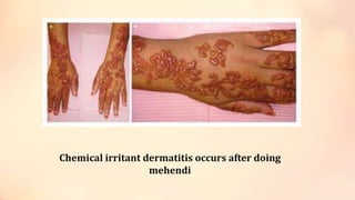 Chemical irritant dermatitis occurs after doing
mehendi
 