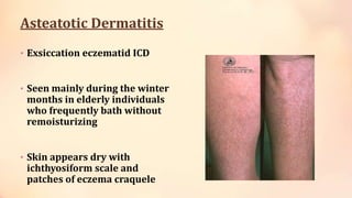 Asteatotic Dermatitis
• Exsiccation eczematid ICD
• Seen mainly during the winter
months in elderly individuals
who frequently bath without
remoisturizing
• Skin appears dry with
ichthyosiform scale and
patches of eczema craquele
 