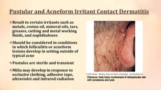 Pustular and Acneform Irritant Contact Dermatitis
Result to certain irritants such as
metals, croton oil, mineral oils, tars,
greases, cutting and metal working
fluids, and naphthalenes
Should be considered in conditions
in which folliculitis or acneform
lesions develop in setting outside of
typical acne
Pustules are sterile and transient
Milia may develop in response to
occlusive clothing, adhesive tape,
ultraviolet and infrared radiation
Chloracne. Note heavy involvement of retroauricular skin
with comedones and cysts
 