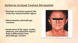 Airborne Irritant Contact Dermatitis
Develops on irritant-exposed skin
of the face and periorbital regions
Often simulates photoallergic
reactions
Involvement of the upper eyelids,
philtrum, and submental regions
help to differentiate from
photoallergic reaction
 