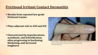 Frictional Irritant Contact Dermatitis
Results from repeated low-grade
frictional trauma
Plays adjuvant role in ACD and ICD
Characterized by hyperkeratosis,
acanthosis, and lichenification,
often progressing to hardening,
thickening, and increased
toughness
9 year old girl demonstrates a lichenified hyperpigmented round plaque on
the top of her thumb produced by chronic thumbsucking.
www.dermatlas.org
 