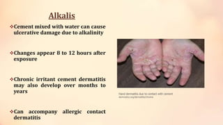 Alkalis
Cement mixed with water can cause
ulcerative damage due to alkalinity
Changes appear 8 to 12 hours after
exposure
Chronic irritant cement dermatitis
may also develop over months to
years
Can accompany allergic contact
dermatitis
Hand dermatitis due to contact with cement
dermnetnz.org/dermatitis/chrome
 