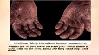 Professional paint and crayon illustrator with bilateral palmar dermatitis secondary to
repeated contact with paint solvents. Extensive patch testing excluded allergic contact
dermatitis
 