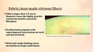 Fabric/man-made vitreous fibers
Fibers larger than 3.5 um in
diameter cause the highly pruritic
contact dermatitis caused by
fiberglass
Erythematous papules with
superimposed excoriations on neck
and dorsal hands
Wool and rough clothing cause
dermatitis in atopic individuals
Fiberglass dermatitis www.cdc.gov/niosh/ocderm
 