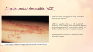 Allergic contact dermatitis (ACD)
• ACD accounts for approximately 20% of all
contact dermatitis
• ACD is a type IV, delayed or cell-mediated
immune reaction that is elicited when the skin
comes in contact with a chemical to which an
individual has been previously sensitized
• Synonyms include contact dermatitis and
contact eczema
Allergic contact dermatitis. Linear streaks seen with ACD to poison ivy.
 