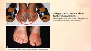• Allergic contact dermatitis to
leather shoes. Note the
correspondence to sites of exposure.
Courtesy of Yale Residents Slide Collection.
 