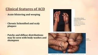 Clinical features of ACD
• Acute blistering and weeping
• Chronic lichenified and scaly
plaques
• Patchy and diffuse distributions
may be seen with body washes and
shampoos
 Acute bullous allergic
contact dermatitis due to
poison ivy. This
distribution is seen in
patients who wear gloves.
Courtesy of Yale Residents
Slide Collection
 Chronic allergic contact dermatitis
due to glutaraldehyde. The patient was
an optometrist
 