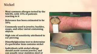 Nickel
• Most common allergen tested by the
NACDG, with 14% of patients
reacting to it
• Relevance has been estimated to be
50%
• Commonly used in jewelry, buckles,
snaps, and other metal-containing
objects
• High rate of sensitivity attributed to
ear piercing
• Dimethylglyoxime test to determine
if a particular item contains nickel
• Individuals with nickel allergy
should avoid custom jewelry, and
can usually wear stainless steel or
 
