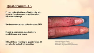 Quaternium-15
• Preservative that is an effective biocide
against Pseudomonas, as well as other
bacteria and fungi
• Most common preservative to cause ACD
• Found in shampoos, moisturizers,
conditioners, and soaps
• 80% of those reacting to quarternium-15
are also formaldehyde sensitive
Hand dermatititis due to
quaternium-15 in a moisturiser
dermnetnz.org/dermatitis/quaternium
 