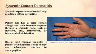 Systemic Contact Dermatitis
• Systemic exposure to a chemical may
result in a diffuse dermatitis
• Patient has had a prior contact
allergy and then becomes exposed
through a systemic route, such as
injection, oral, intravenous, or
intranasal administration
• One of most common examples is
patient with ethylenediamine allergy
and subsequent reaction to
aminophylline
 