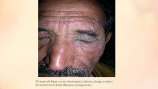 55-year-old farm worker developed a chronic allergic contact
dermatitis to airborn allergens (compositae).
 