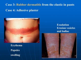 contact dermatitis in adults and children.ppt