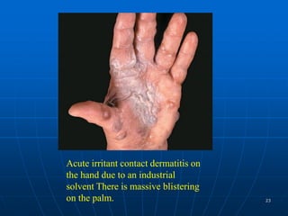 Dermatitis Repens contact dermatitis in adults and children.ppt