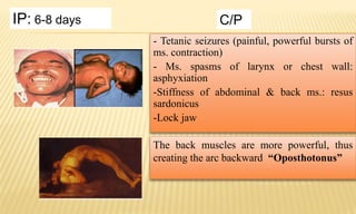 - Tetanic seizures (painful, powerful bursts of
ms. contraction)
- Ms. spasms of larynx or chest wall:
asphyxiation
-Stiffness of abdominal & back ms.: resus
sardonicus
-Lock jaw
IP: 6-8 days C/P
The back muscles are more powerful, thus
creating the arc backward “Oposthotonus”
 