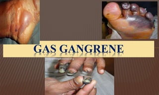 GAS GANGRENE
 