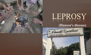 LEPROSY
(Hansen's disease)
 