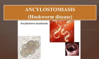 ANCYLOSTOMIASIS
(Hookworm disease)
 