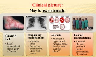 Clinical picture:
May be asymptomatic.
Ground
itch
• Local
dermatitis at
site of entry
of larvae.
Respiratory
manifestations
• Migrating
larvae
• Patchy lung
consolidation,
Upper resp.
catarrh.
Anaemia
• Microcytic
hypochromic
“chronic blood
loss by worm
sucking
blood”.
General
manifestations
• Retarded
physical
growth &
mental
development
of children.
 