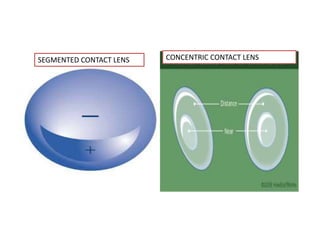 SEGMENTED CONTACT LENS CONCENTRIC CONTACT LENS
 