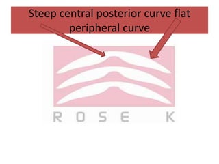 Steep central posterior curve flat
peripheral curve
 