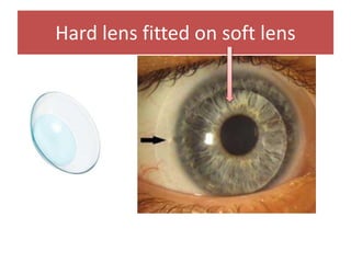 Hard lens fitted on soft lens
 