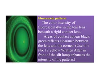 Fluorescein pattern:
The color intensity of
fluorescein dye in the tear lens
beneath a rigid contact lens.
Areas of contact appear black;
green reflects clearance between
the lens and the cornea. (Use of a
No. 12 yellow Wratten Alter in
front of the slit lamp enhances the
intensity of the pattern.)
 