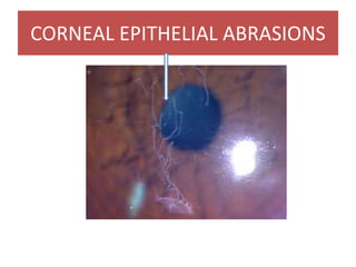 CORNEAL EPITHELIAL ABRASIONS
 