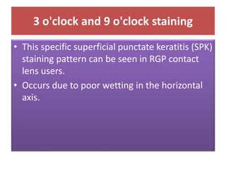 3 o'clock and 9 o'clock staining
• This specific superficial punctate keratitis (SPK)
staining pattern can be seen in RGP contact
lens users.
• Occurs due to poor wetting in the horizontal
axis.
 