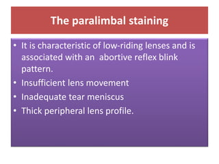 The paralimbal staining
• It is characteristic of low-riding lenses and is
associated with an abortive reflex blink
pattern.
• Insufficient lens movement
• Inadequate tear meniscus
• Thick peripheral lens profile.
 