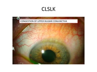 CLSLK
CONGESTION OF UPPER BULBAR CONJUNCTIVA
 